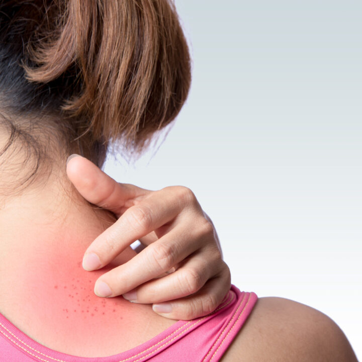 Teruglezen: Cosmetica-allergie