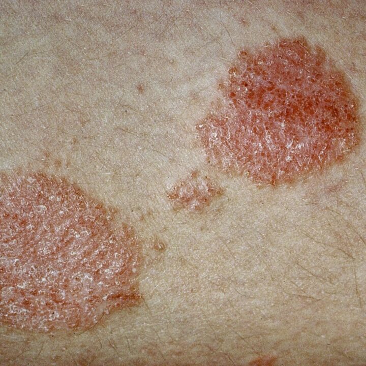Nieuw! Column dermatologie: Een rood schilferende huid, van buiten naar binnen