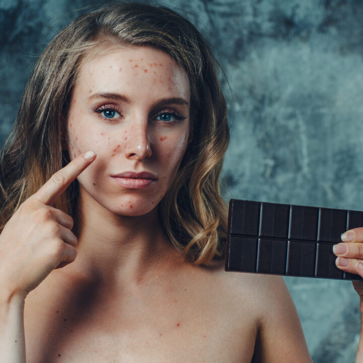 Jouw klant vraagt om voedingsadvies bij acne. Wat zeg jij dan?