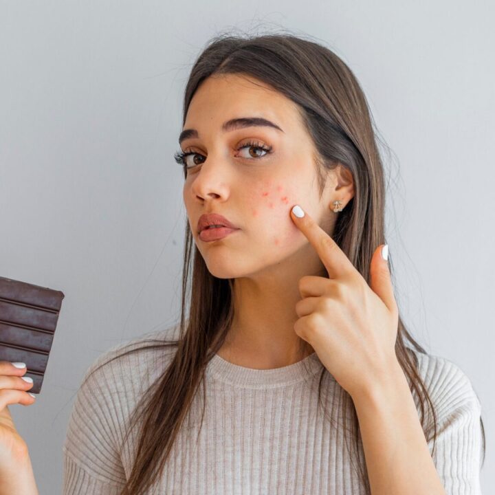 De relatie tussen acne en chocolade… Hoe zit het nu echt?