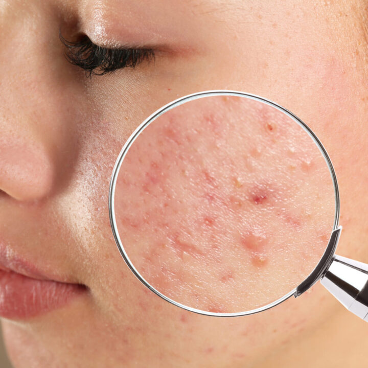 Voeding geen veroorzaker van acne. Hoe zit het nu echt?