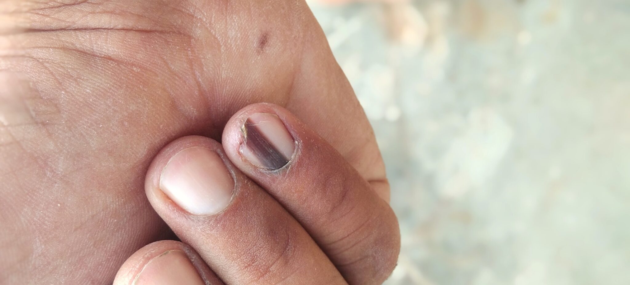 Sneak peak Melanomen op en rond de vingernagels BeautyPro.nl