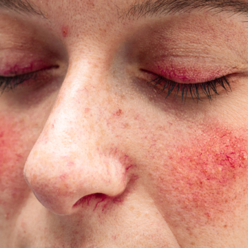 Rosacea en natuurlijke ingrediënten: praktische adviezen