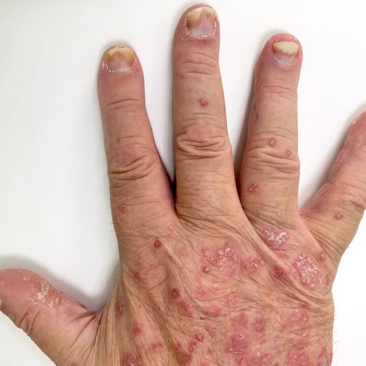 Psoriasis in de nagels