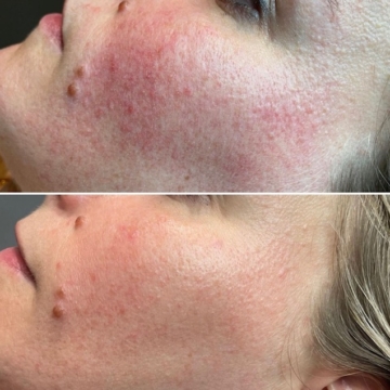 Show your best results: Roodheid en Rosacea verminderen met IPL/Laser