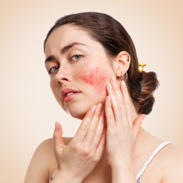 KIVH: Voedingsadvies bij rosacea, hoe pak je dit aan?