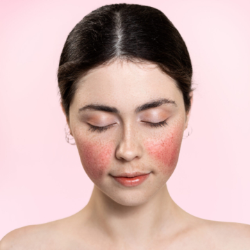 KIVH in beurseditie: Voeding & rosacea, stop met standaard triggerlijstjes