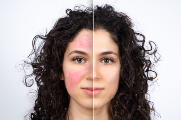 rosacea niacinamide