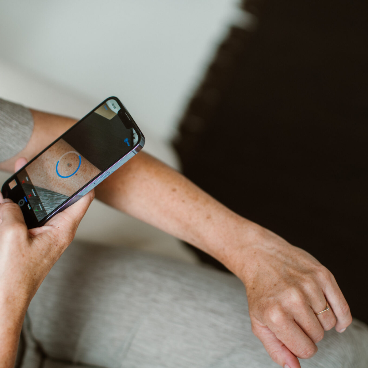 SkinVision-app ontvangt officiële medische EU-goedkeuring voor huidkankercontrole
