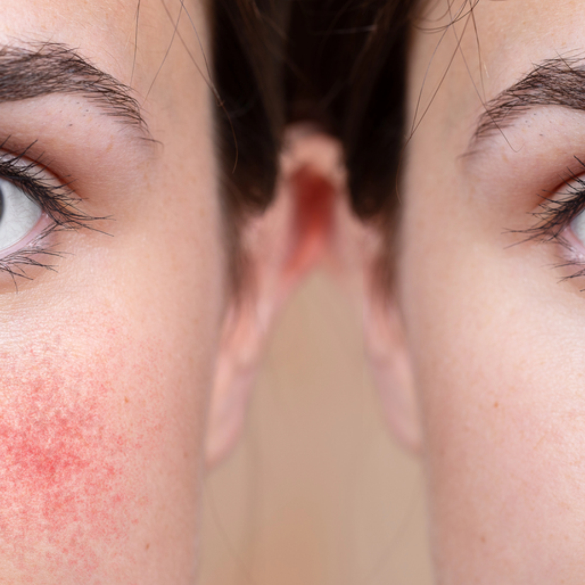 Rosacea of couperose: wat is het verschil?