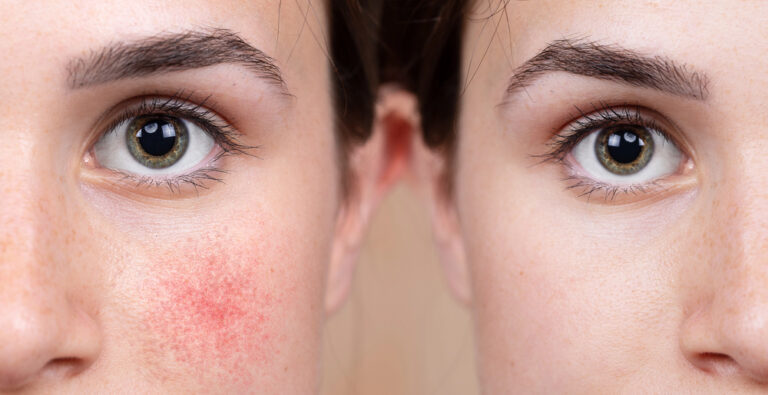 Rosacea of couperose: wat is het verschil?