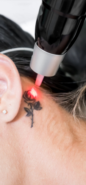 Brancheorganisaties zetten grenzen bij tattoo removal