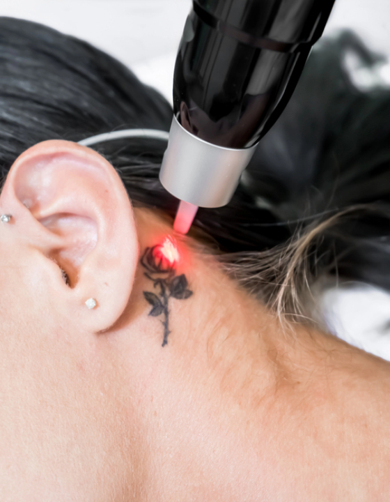 Brancheorganisaties zetten grenzen bij tattoo removal