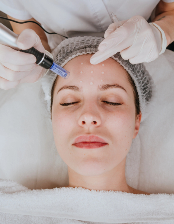 ANBOS scherpt eisen microneedling en oncologische huidzorg aan