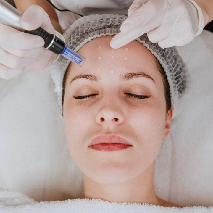 ANBOS scherpt eisen microneedling en oncologische huidzorg aan