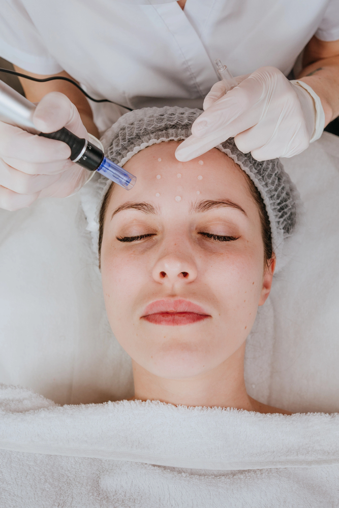 ANBOS scherpt eisen microneedling en oncologische huidzorg aan