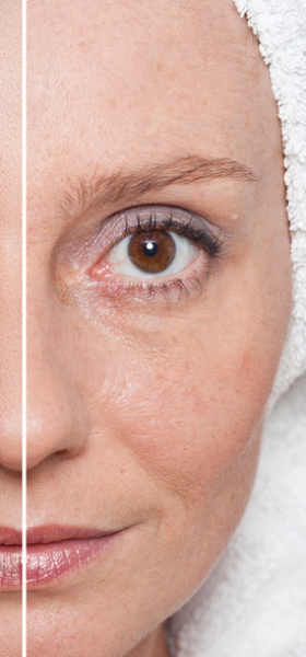 Is huidveroudering in de overgang aantoonbaar te verbeteren?