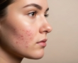 SPF, UVA en fotoprotectie: hoe zit het precies?